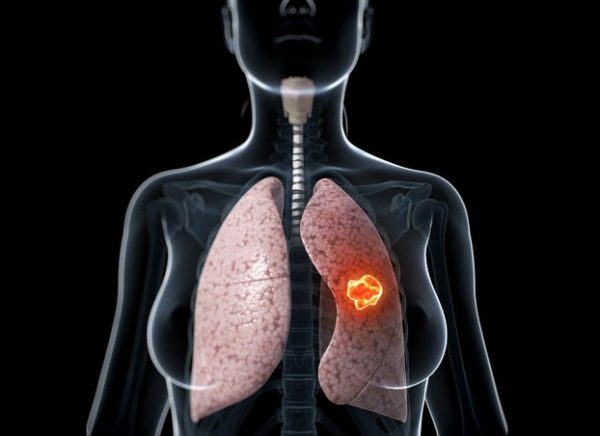 Người mắc bệnh ung thư phổi giai đoạn cuối nên ăn gì?