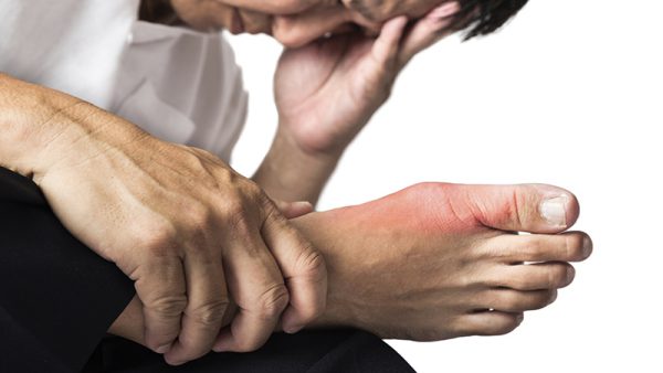 Người bị gout