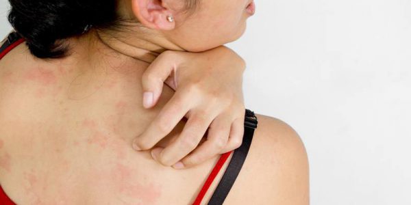Dị ứng thời tiết